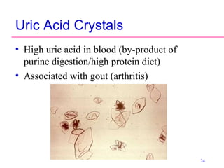 24
Uric Acid Crystals
• High uric acid in blood (by-product of
purine digestion/high protein diet)
• Associated with gout (arthritis)
 