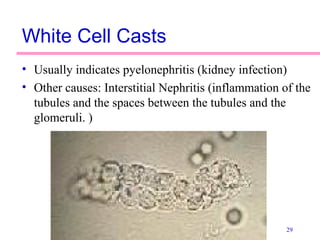 29
White Cell Casts
• Usually indicates pyelonephritis (kidney infection)
• Other causes: Interstitial Nephritis (inflammation of the
tubules and the spaces between the tubules and the
glomeruli. )
 