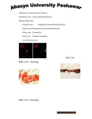 Erythrocyte Casts:Glomerular diseases
Leukocyte Casts: Pyuria, glomerular disease
Degenerating Casts:
- Granular casts Nonspecific (Tamm-Horsfall protein)
- Hyaline castsNonspecific (Tamm-Horsfall protein)
- Waxy casts Nonspecific
- Fatty casts Nephrotic syndrome
(oval fat body casts)
RBCs Cast
RBCs Cast - Histology
RBCs Cast - Histology
Prepared by Amjad khan
 
