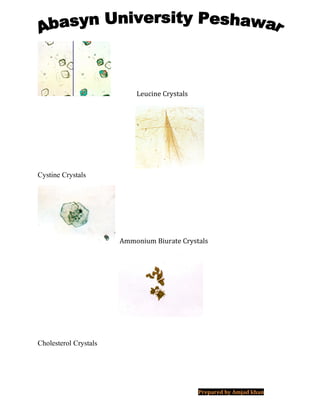 Leucine Crystals
Cystine Crystals
Ammonium Biurate Crystals
Cholesterol Crystals
Prepared by Amjad khan
 