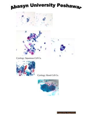 Cytology: Squamous Cell Ca.
Cytology: Renal Cell Ca.
Prepared by Amjad khan
 
