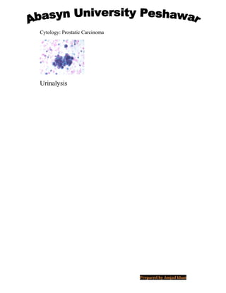 Cytology: Prostatic Carcinoma
Urinalysis
Prepared by Amjad khan
 