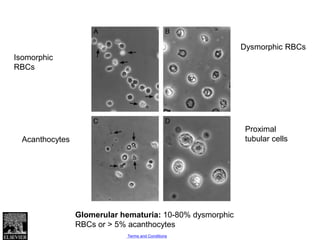 Eumorphic Rbc Urinalysis | PPTX
