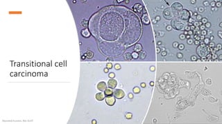 Transitional cell
carcinoma
Alyazeed hussein, BSc-SUST
 