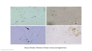 Mucus threads: infections of lower urinary and vaginal tract.
Alyazeed hussein, BSc-SUST
 