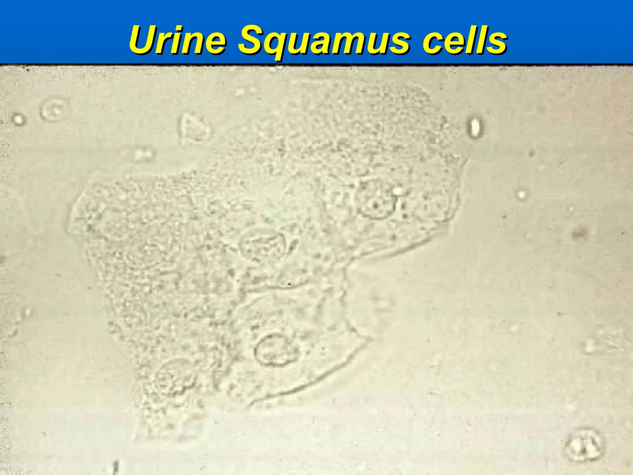 Urine Squamus cells 