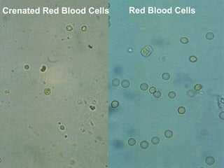 Red Blood Cells Crenated Red Blood Cells 