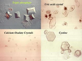 Cystine Triple phosphate Uric acid crystal Calcium Oxalate Crystals 