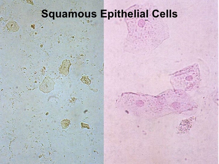 How do squamous cells get in urine?