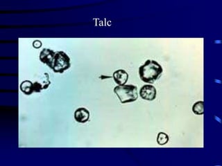 Talc Test Urinalysis; urine examination in the lab.ppt