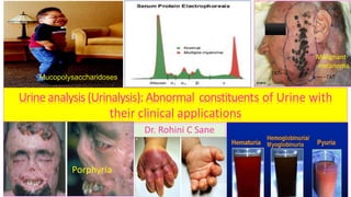 Dr. Rohini C Sane
Urineanalysis(Urinalysis): Abnormal constituents of Urine with
their clinical applications
Malignant
melanoma
Mucopolysaccharidoses
Porphyria
 