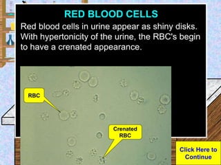 Mild Crenation Rbc Urinalysis lab powerpoint.ppt