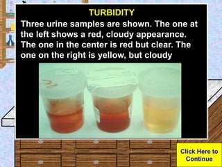 Urine Sample
TURBIDITY
Three urine samples are shown. The one at
the left shows a red, cloudy appearance.
The one in the c...