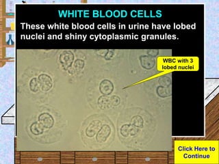 Urine Sample
WHITE BLOOD CELLS
These white blood cells in urine have lobed
nuclei and shiny cytoplasmic granules.
Click He...