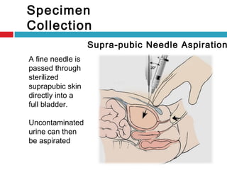 Specimen
Collection
Supra-pubic Needle Aspiration
A fine needle is
passed through
sterilized
suprapubic skin
directly into a
full bladder.
Uncontaminated
urine can then
be aspirated
 