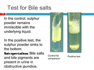 Test for Bile salts
78
Control for
comparison
Positive test
In the control, sulphur
powder remains
immiscible with the
underlying liquid.
In the positive test, the
sulphur powder sinks to
the bottom.
Interpretation: Bile salts
and bile pigments are
present in urine in
obstructive jaundice.
 