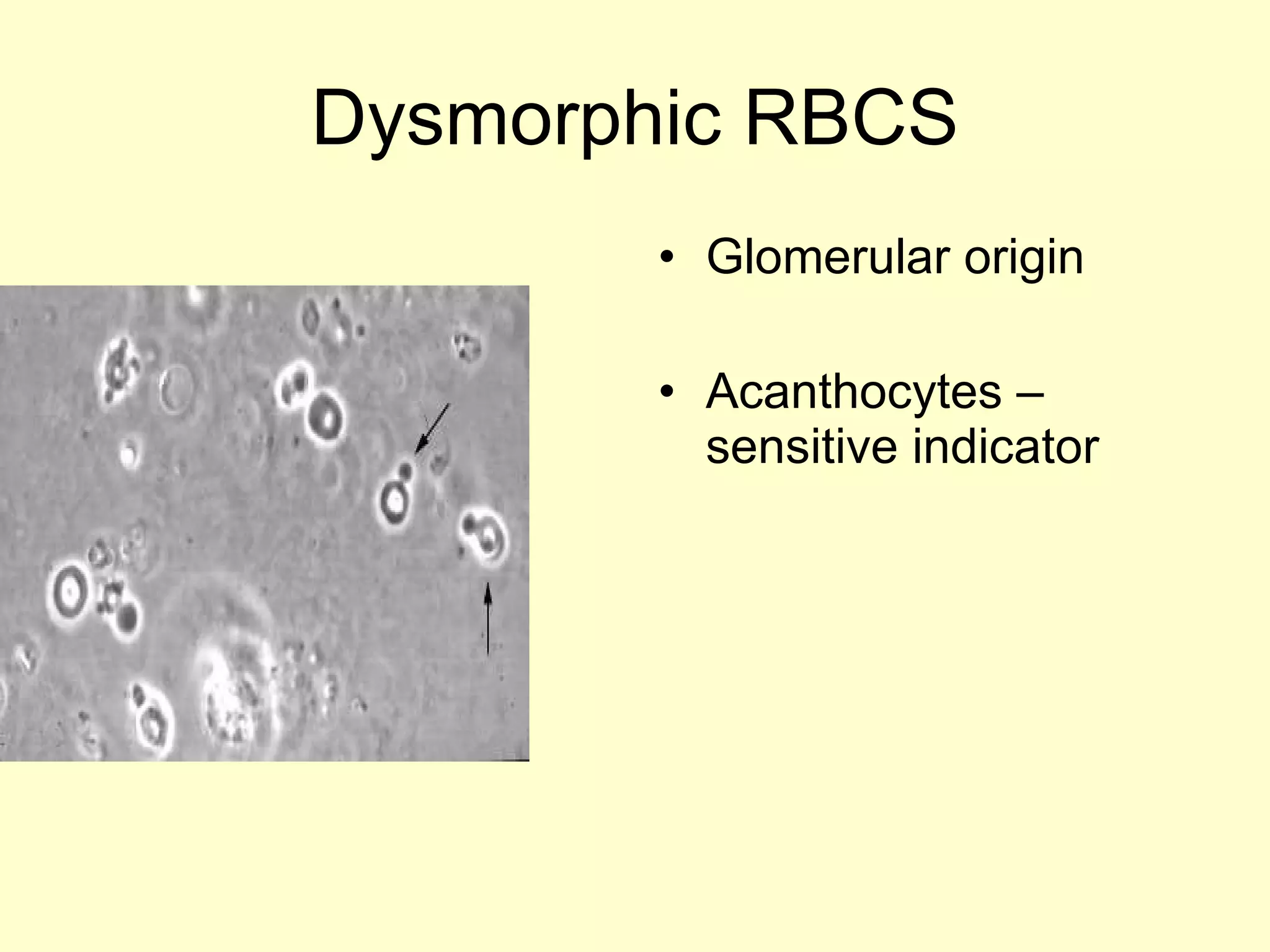 Dysmorphic RBCS Glomerular origin Acanthocytes – sensitive indicator  