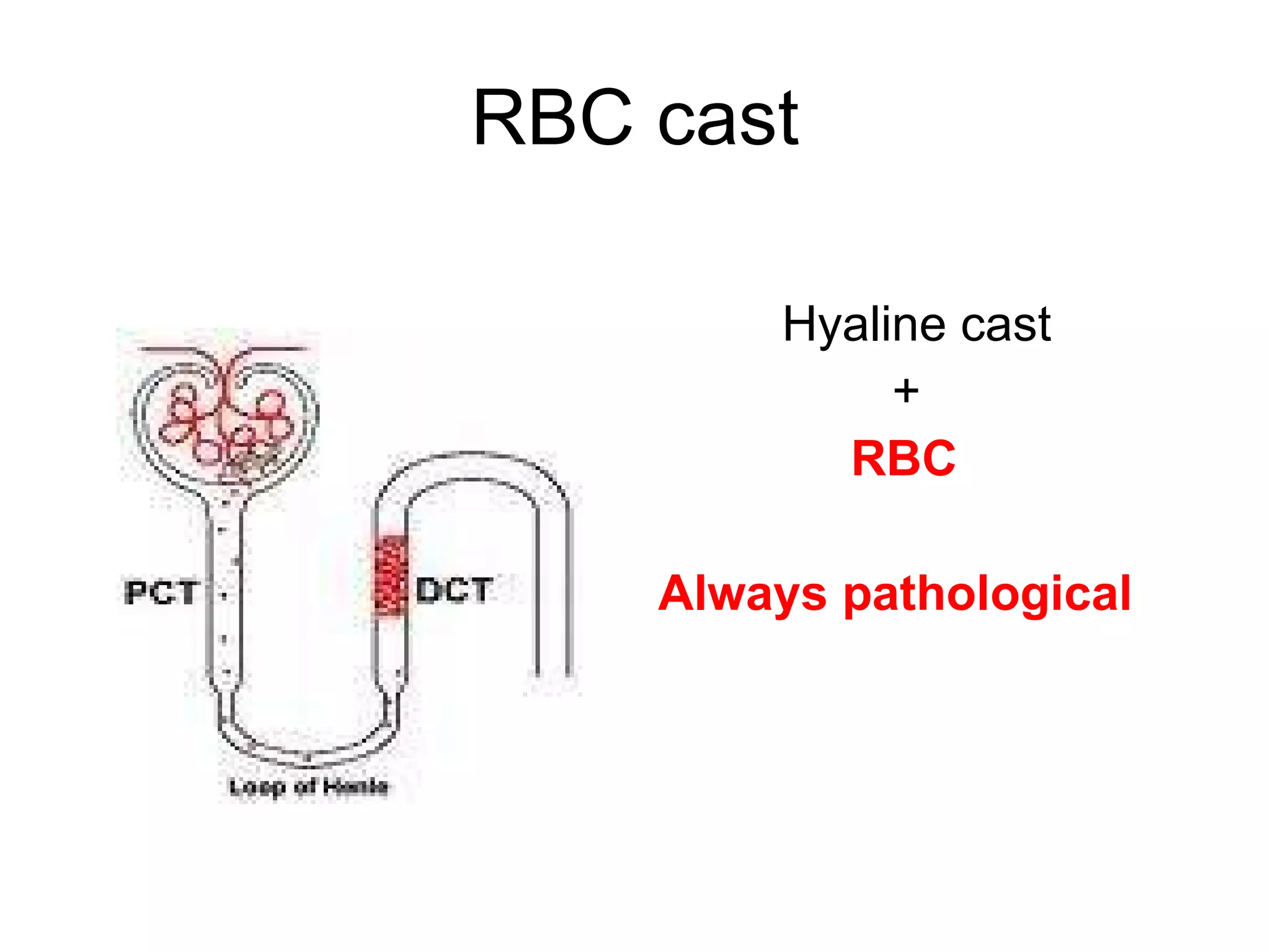 RBC cast Hyaline cast + RBC Always pathological 