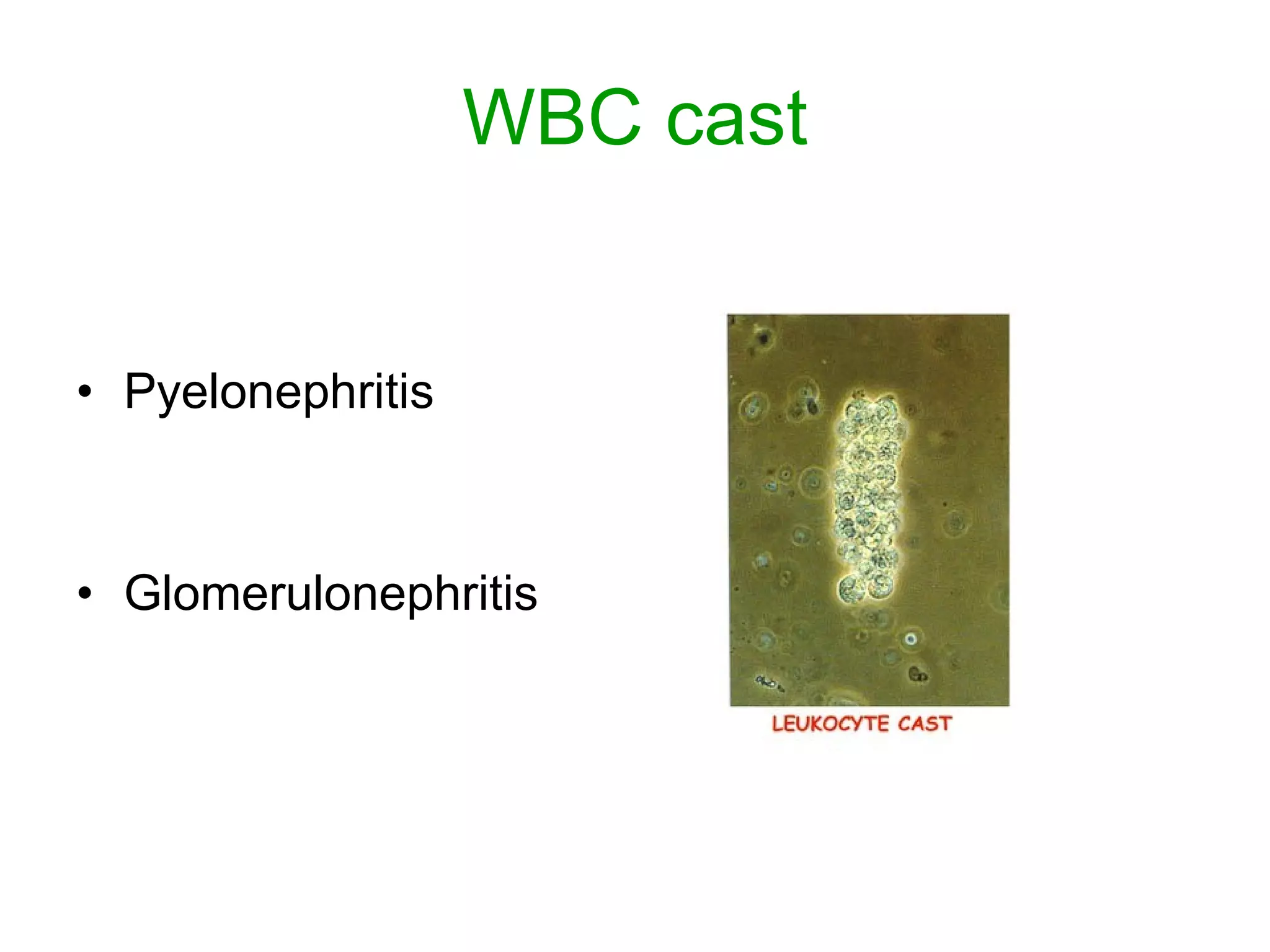WBC cast Pyelonephritis Glomerulonephritis 