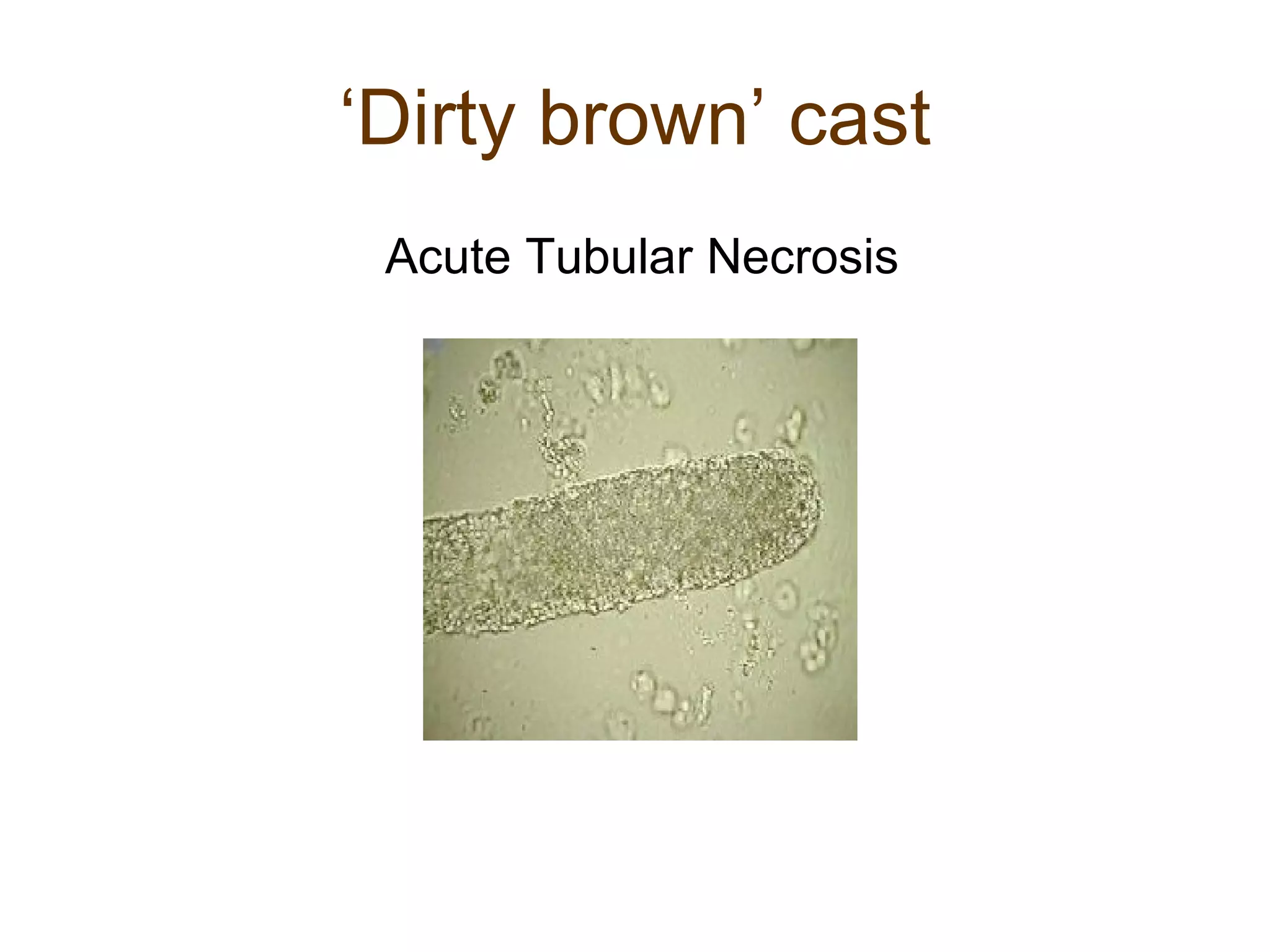 ‘ Dirty brown’ cast Acute Tubular Necrosis 