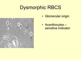 Dysmorphic RBCS Glomerular origin Acanthocytes – sensitive indicator  