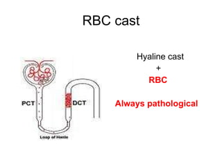 RBC cast Hyaline cast + RBC Always pathological 
