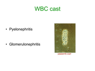 WBC cast Pyelonephritis Glomerulonephritis 