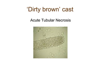 ‘ Dirty brown’ cast Acute Tubular Necrosis 