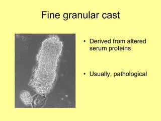 Fine granular cast Derived from altered serum proteins Usually, pathological 