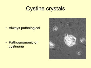 Cystine crystals Always pathological Pathognomonic of cystinuria 