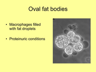 Oval fat bodies Macrophages filled with fat droplets Proteinuric conditions 