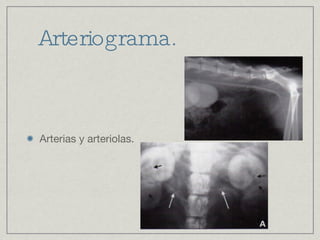 Arteriograma. Arterias y arteriolas. 