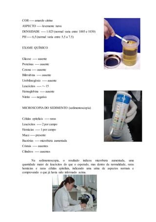 COR ---- amarelo citrino 
ASPECTO ---- levemente turva 
DENSIDADE ---- 1.025 (normal varia entre 1005 e 1030) 
PH ---- 6,5 (normal varia entre 5,5 a 7.5) 
EXAME QUÍMICO 
Glicose ---- ausente 
Proteínas ---- ausente 
Cetona ---- ausente 
Bilirrubina ---- ausente 
Urobilinogênio ---- ausente 
Leucócitos ---- +- 15 
Hemoglobina ---- ausente 
Nitrito ---- negativo 
MICROSCOPIA DO SEDIMENTO (sedimentoscopia) 
Células epiteliais ---- raras 
Leucócitos ---- 2 por campo 
Hemácias ---- 1 por campo 
Muco ---- presente 
Bactérias ---- microbiota aumentada 
Cristais ---- ausentes 
Cilindros ---- ausentes 
Na sedimentoscopia, o resultado indicou microbiota aumentada, uma 
quantidade maior de leucócitos do que o esperado, mas dentro da normalidade, raras 
hemácias e raras células epiteliais, indicando uma urina de aspectos normais e 
comprovando o que já havia sido informado acima. 
 