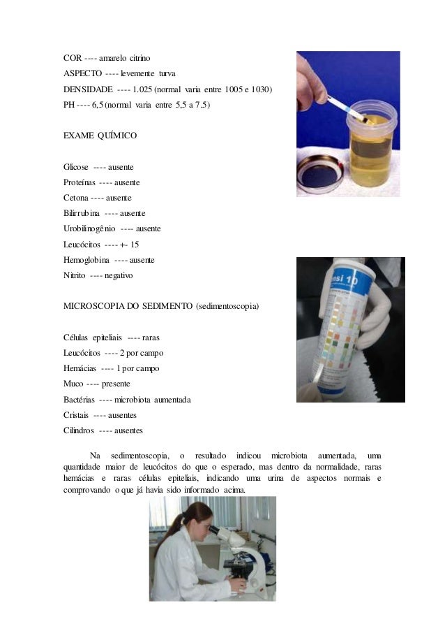 Celulas epiteliais numerosas no exame de urina