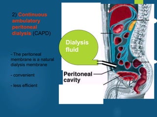 2) Continuous
ambulatory
peritoneal
dialysis (CAPD)
Dialysis
fluid
- The peritoneal
membrane is a natural
dialysis membrane
- convenient
- less efficient
vivek
sir
 