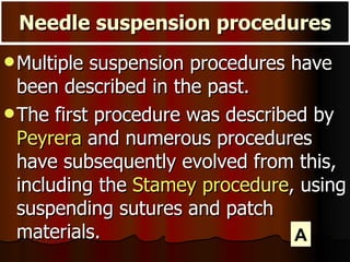 Multiple suspension procedures have been described in the past. The first procedure was described by  Peyrera  and numerous procedures have subsequently evolved from this, including the  Stamey procedure , using suspending sutures and patch materials.  Needle suspension procedures A 