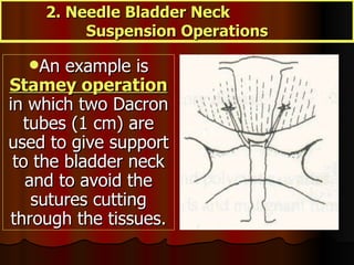 An example is  Stamey operation  in which two Dacron tubes (1 cm) are used to give support to the bladder neck and to avoid the sutures cutting through the tissues. 2. Needle Bladder Neck  Suspension Operations 