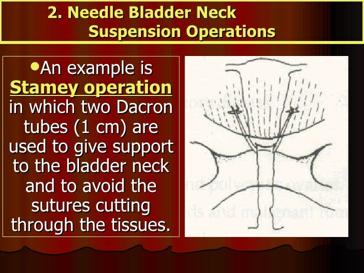 Urinary Incontinence