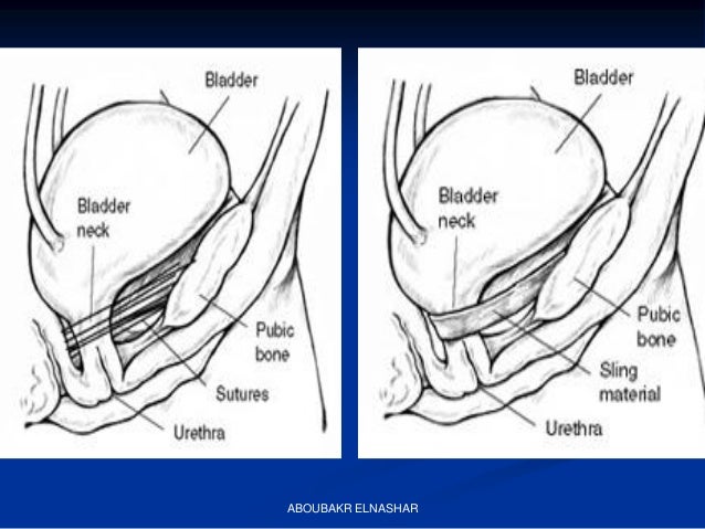 INCONTINENCE OF URINE