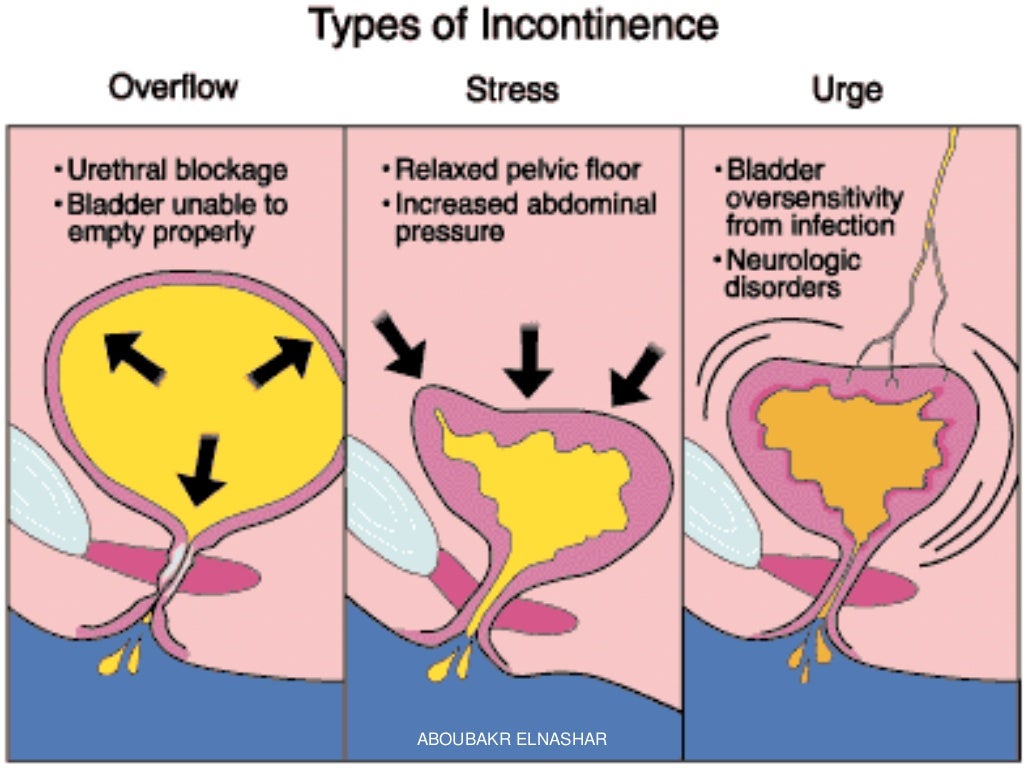 overflow incontinence neurogenic overflow incontinence neurogenic
