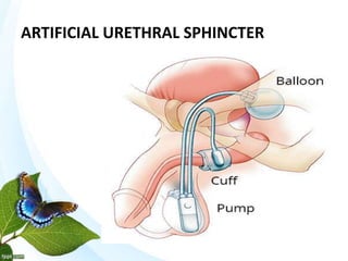 ARTIFICIAL URETHRAL SPHINCTER
 
