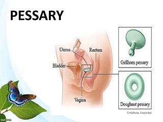 PESSARY
 
