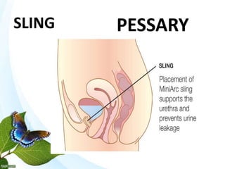SLING PESSARY
 