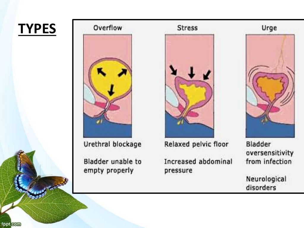 Urinary incontinence
