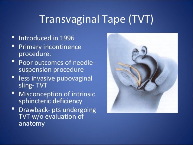 Urinary Incontinence Surgery