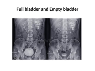 URINARY BLADDER, it’s morphology, attachments | PPTX