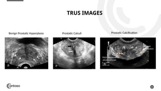 TRUS IMAGES
19
Benign Prostatic Hyperplasia Prostatic Calculi Prostatic Calcification
 