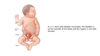 Urinary Bladder Exstrophy.pptx