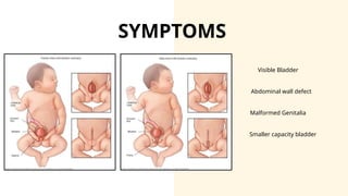 Urinary bladder exstrophy Presentation [Ayushi].pptx