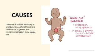 Urinary bladder exstrophy Presentation [Ayushi].pptx